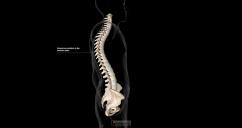 Kyphosis