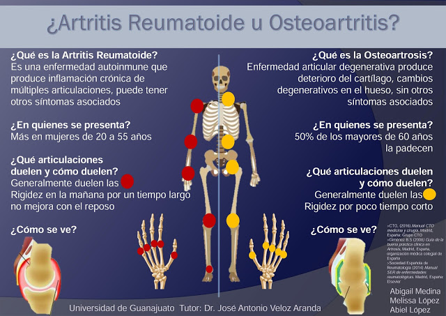 Infographic: ¿Artritis Reumatoide U Osteoartritis? - Manual MSD Versión ...