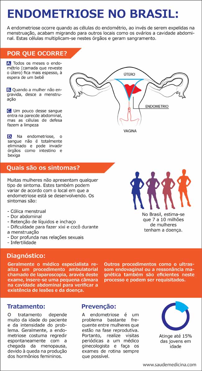 Infographic: Endometriose - Manual MSD Versão Saúde Para A Família