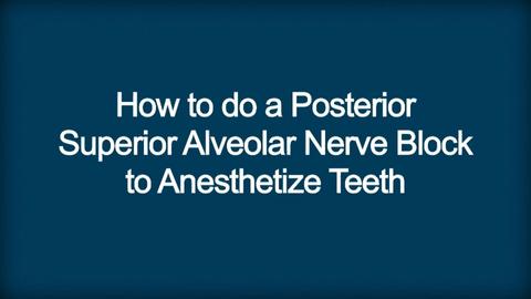 How To Do a Posterior Superior Alveolar Nerve Block to Anesthetize Teeth