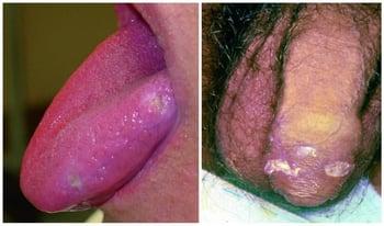 बेशेट रोग में मुंह और जननांगों के छाले