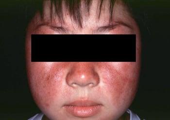 Lupus eritematoso sistemico (eruzione cutanea a farfalla)