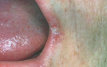 Cheilitis angularis