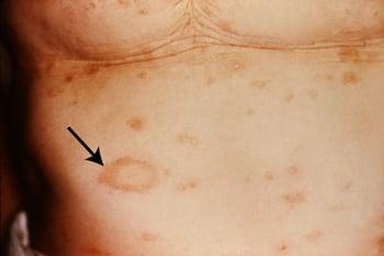 Pityriasis rosé (médaillon)