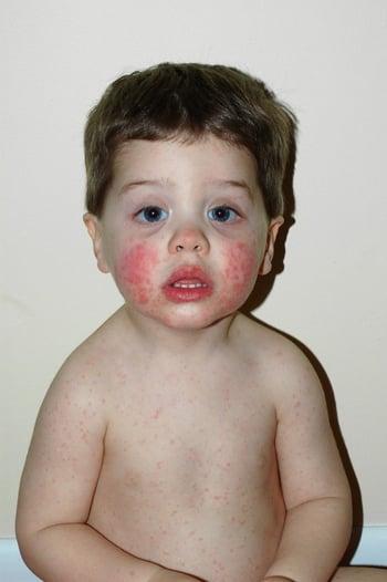 Rash Caused by Erythema Infectiosum