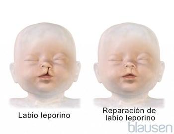 Reparación del labio leporino