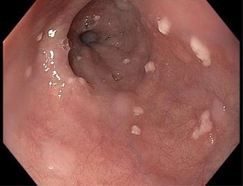 食道のカンジダ（Candida）感染症