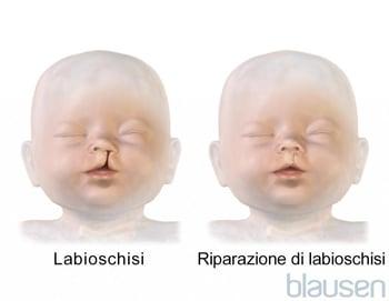 Riparazione di labioschisi