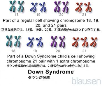 ダウン症候群：21トリソミー