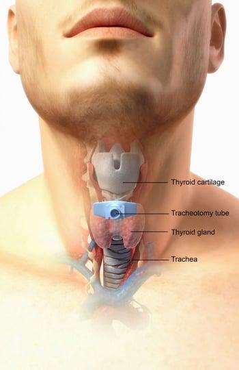 Tracheotomie