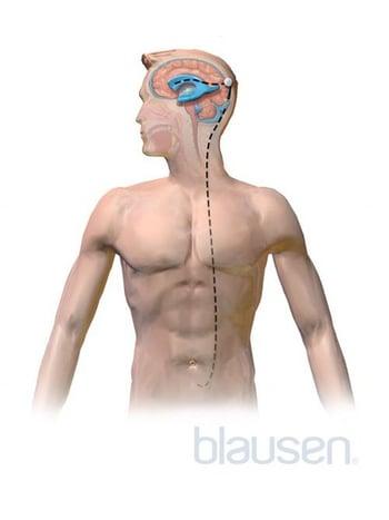 Shunt bei Hydrozephalus