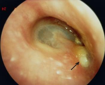 Colesteatoma