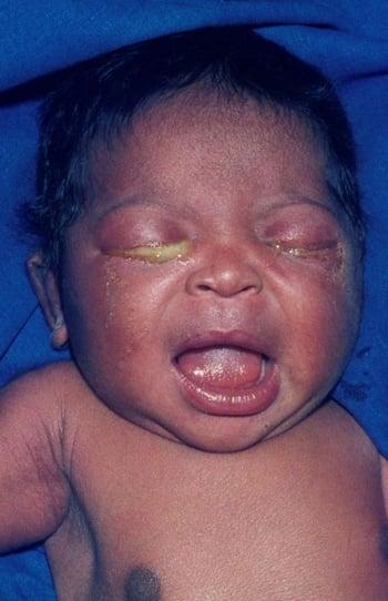 एक नवजात शिशु में कंजंक्टिवाइटिस