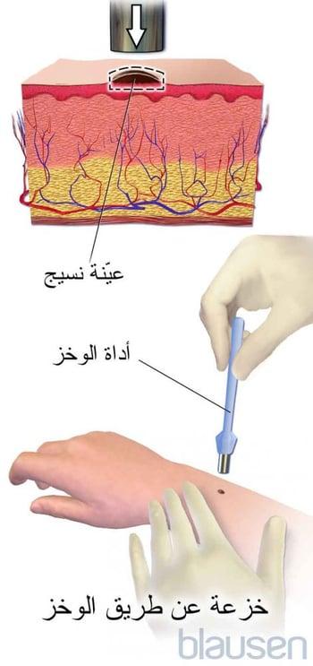 الخزعة بالمقراض