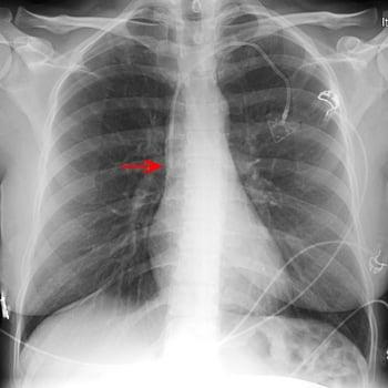 Radiographie d'un cathéter veineux central