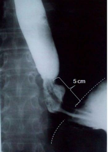 Trago de bario con hernia hiatal deslizante