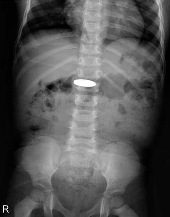 Стороннє тіло в шлунково-кишковому тракті (рентгенограма)