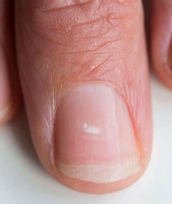 Біла точка на нігті
