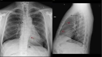 Phim chụp X-quang ngực của một bệnh nhân sau khi phẫu thuật bắc cầu động mạch vành