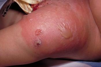 Celulitis