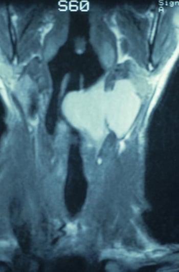 Laringocele combinada