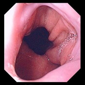 Hernia hiatal