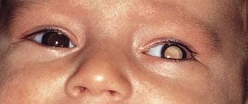 Лейкокорія у дитини з ретинобластомою