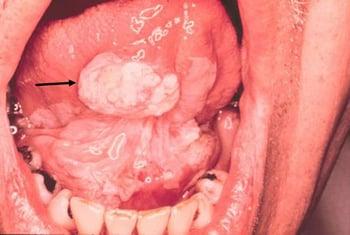 Leucoplachia e carcinoma squamocellulare