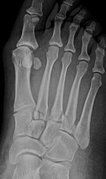 Lisfranc-Frakturen