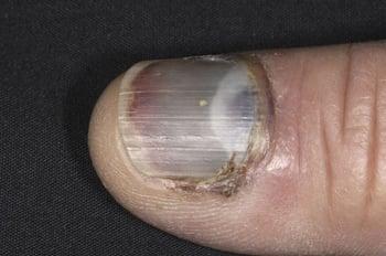 Піднігтьова гематома (на нігтях рук)