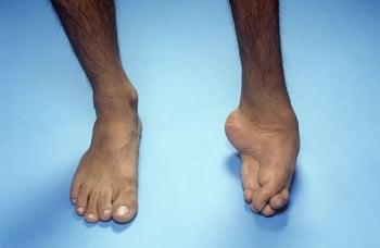 Talipes Equinovarus (Clubfoot)