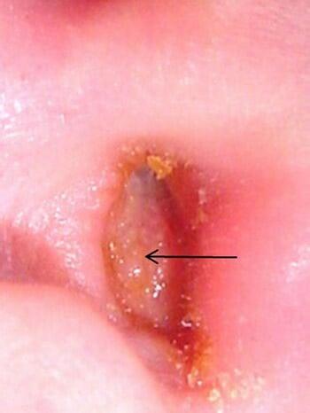 Otite externa com furúnculo