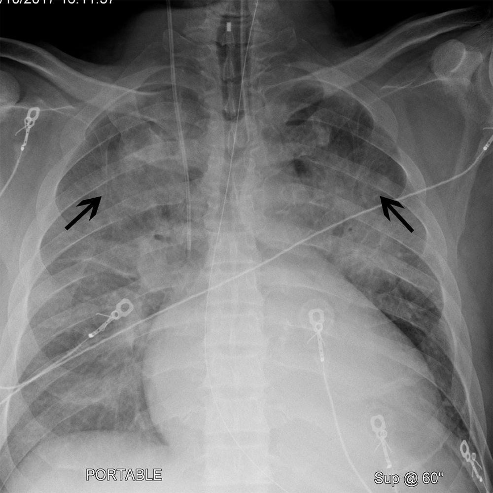 Röntgenthorax eines Patienten mit Kardiomegalie und Kephalisation