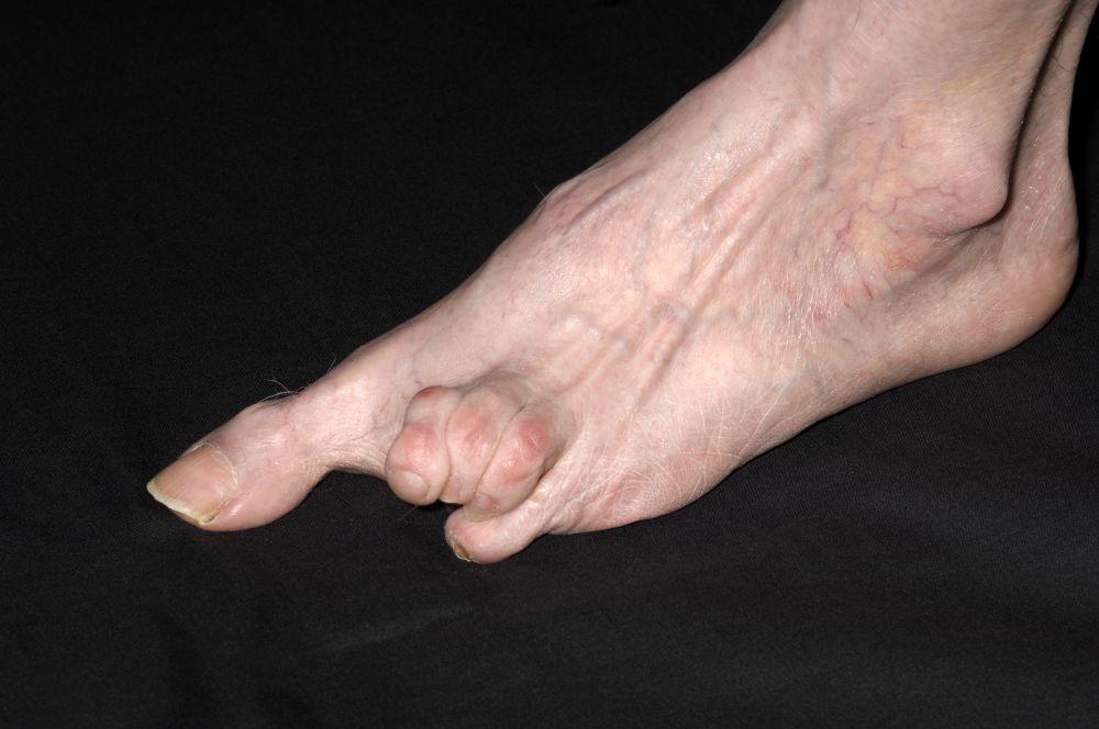 Systemische Sklerose des Fußes